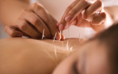 Thinking About Acupuncture? Here’s What You Need to Know