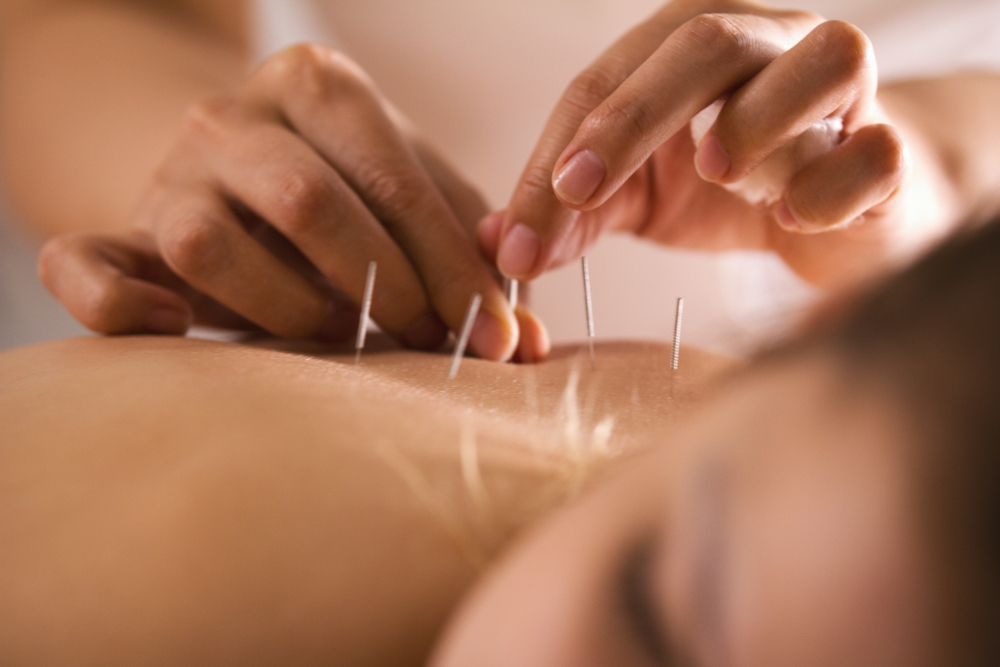 Thinking About Acupuncture? Here’s What You Need to Know